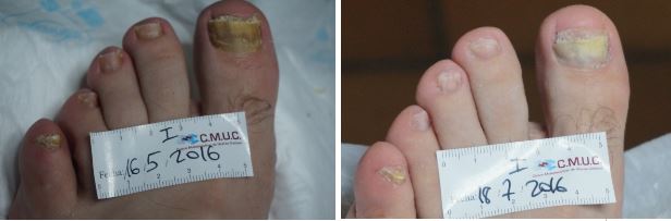 Erradicación de la omicomicosis con k-Láser