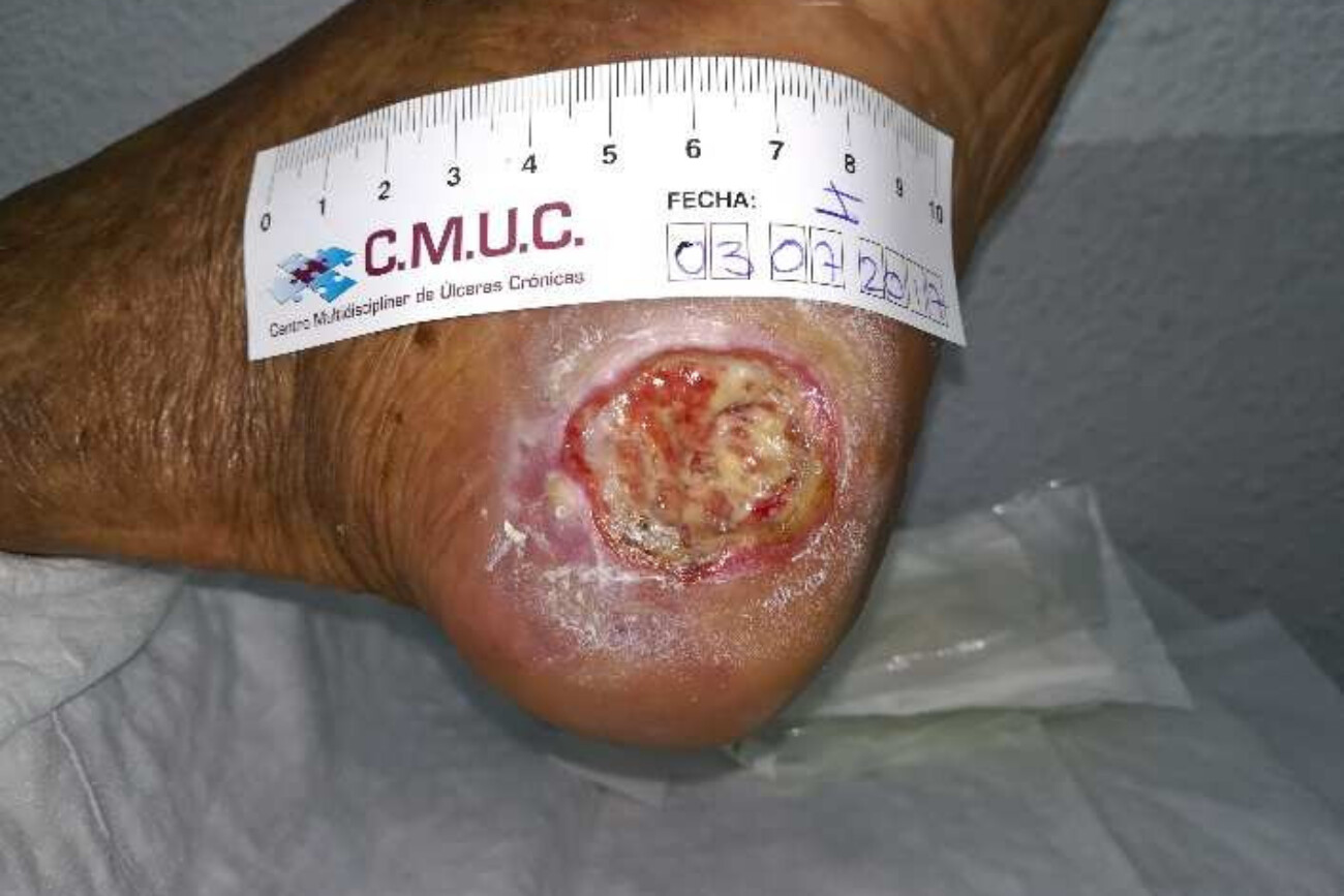 Úlcera antes de colocar la TPNT