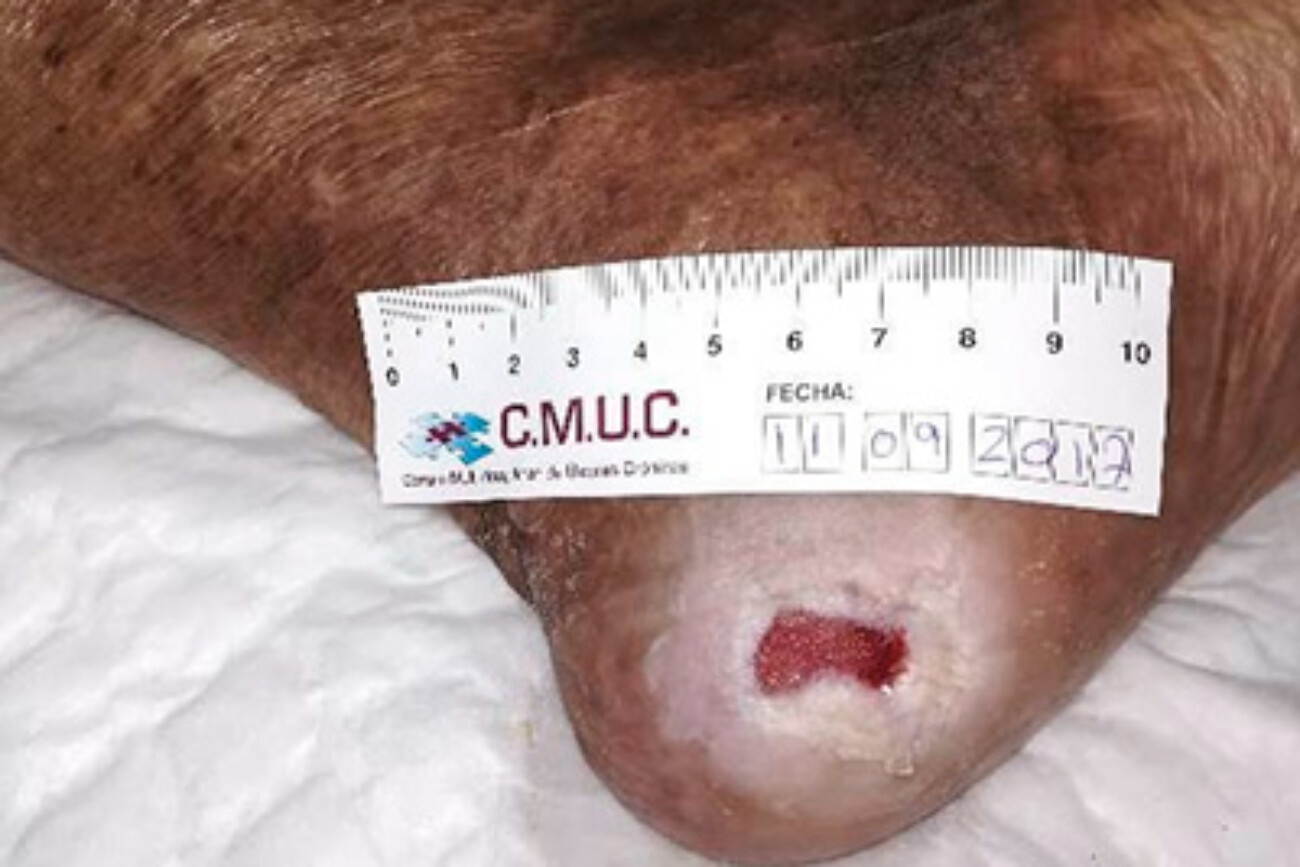 Úlcera tras 1 mes de TPNT