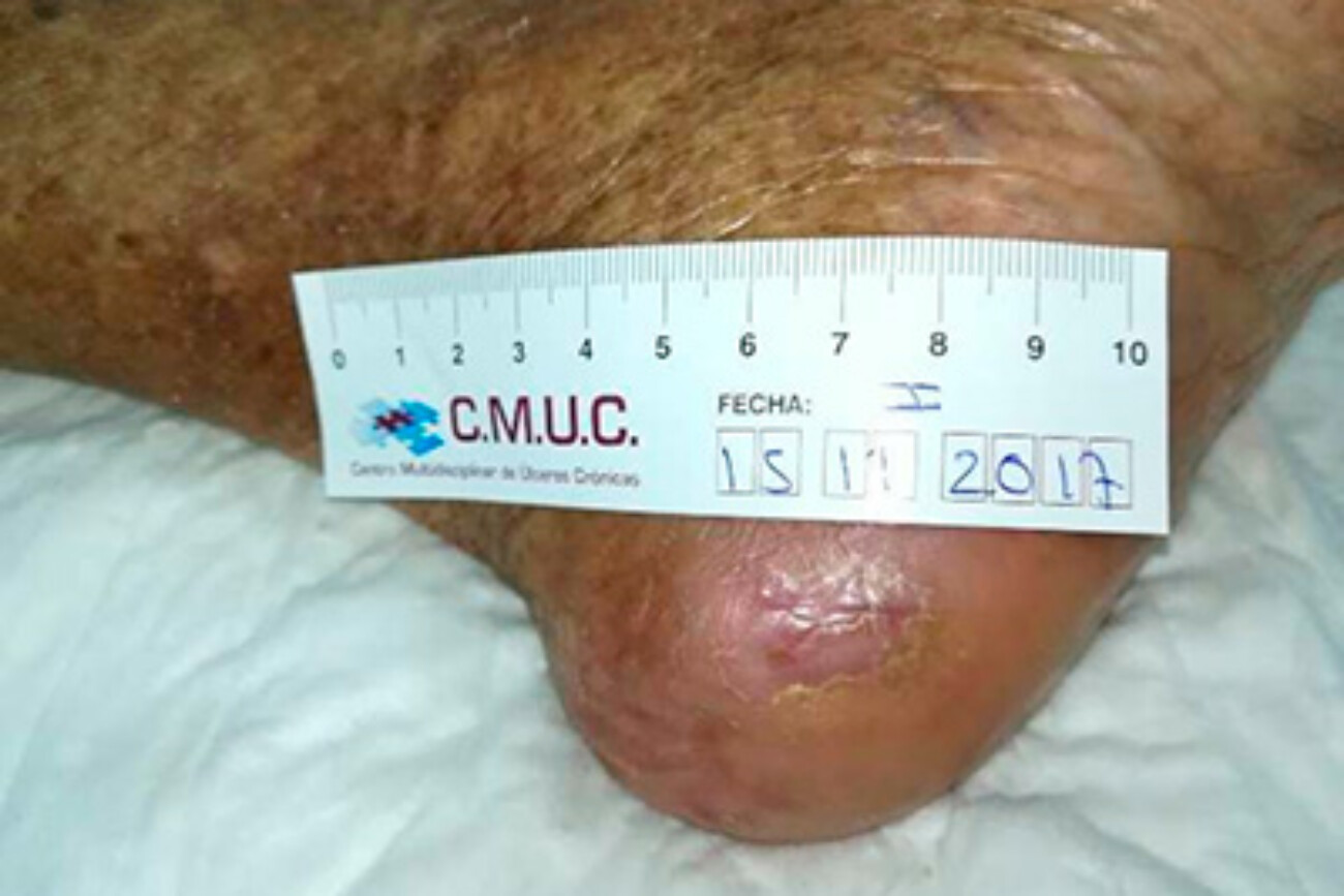 Úlcera tras 3 meses de TPNT