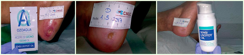 aceite-ozonizado-tratamiento-ulceras