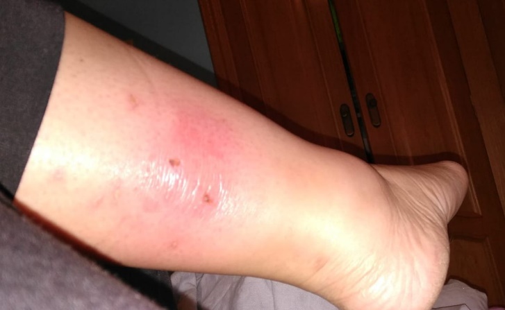 mordedura de gato - caso clinico