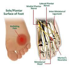 Neuroma de Morton