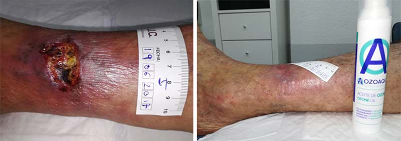 Ozonoterapia en úlceras crónicas y heridas en la piel