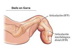 Dedo en garra