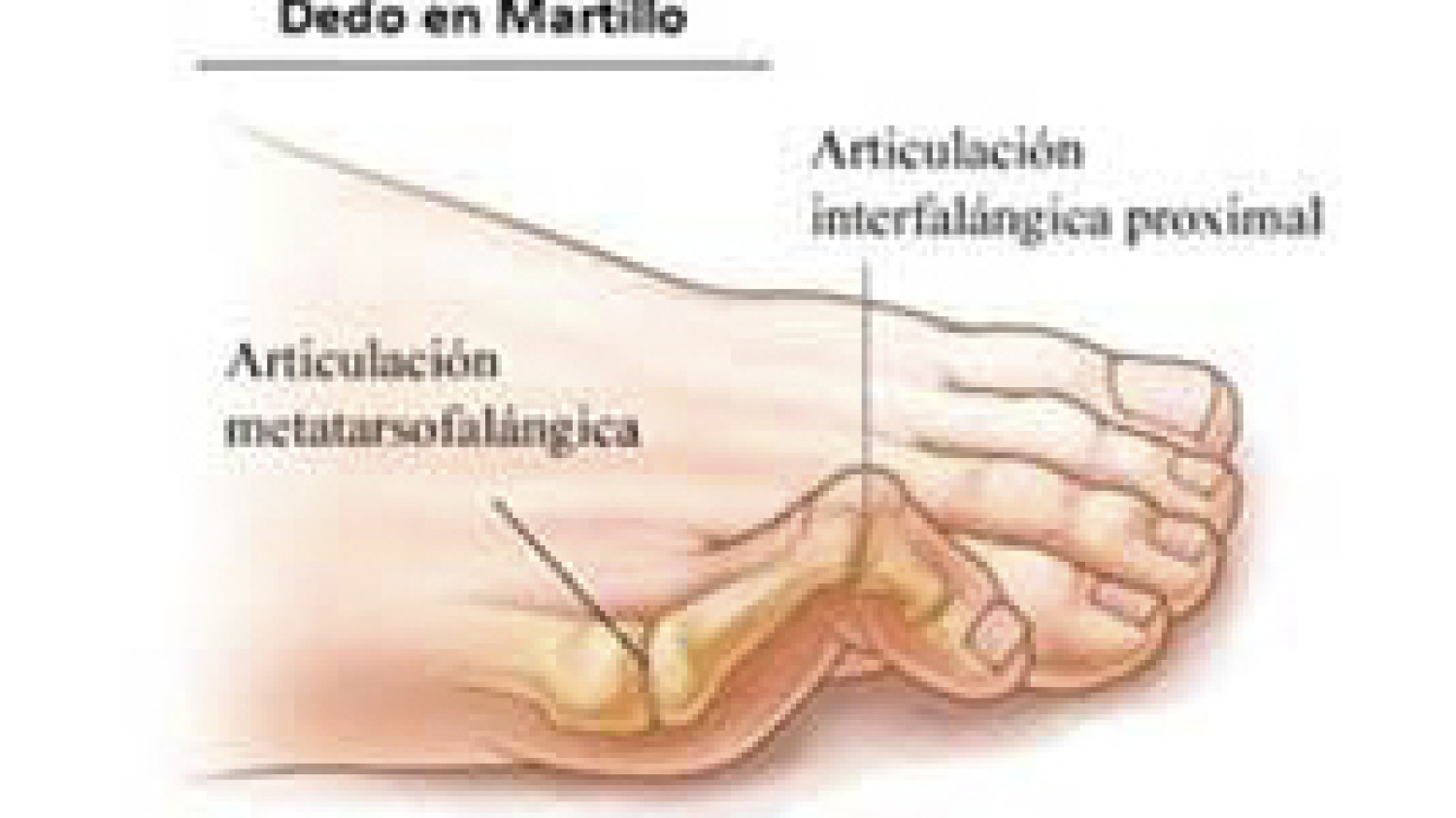 Dedos en martillo