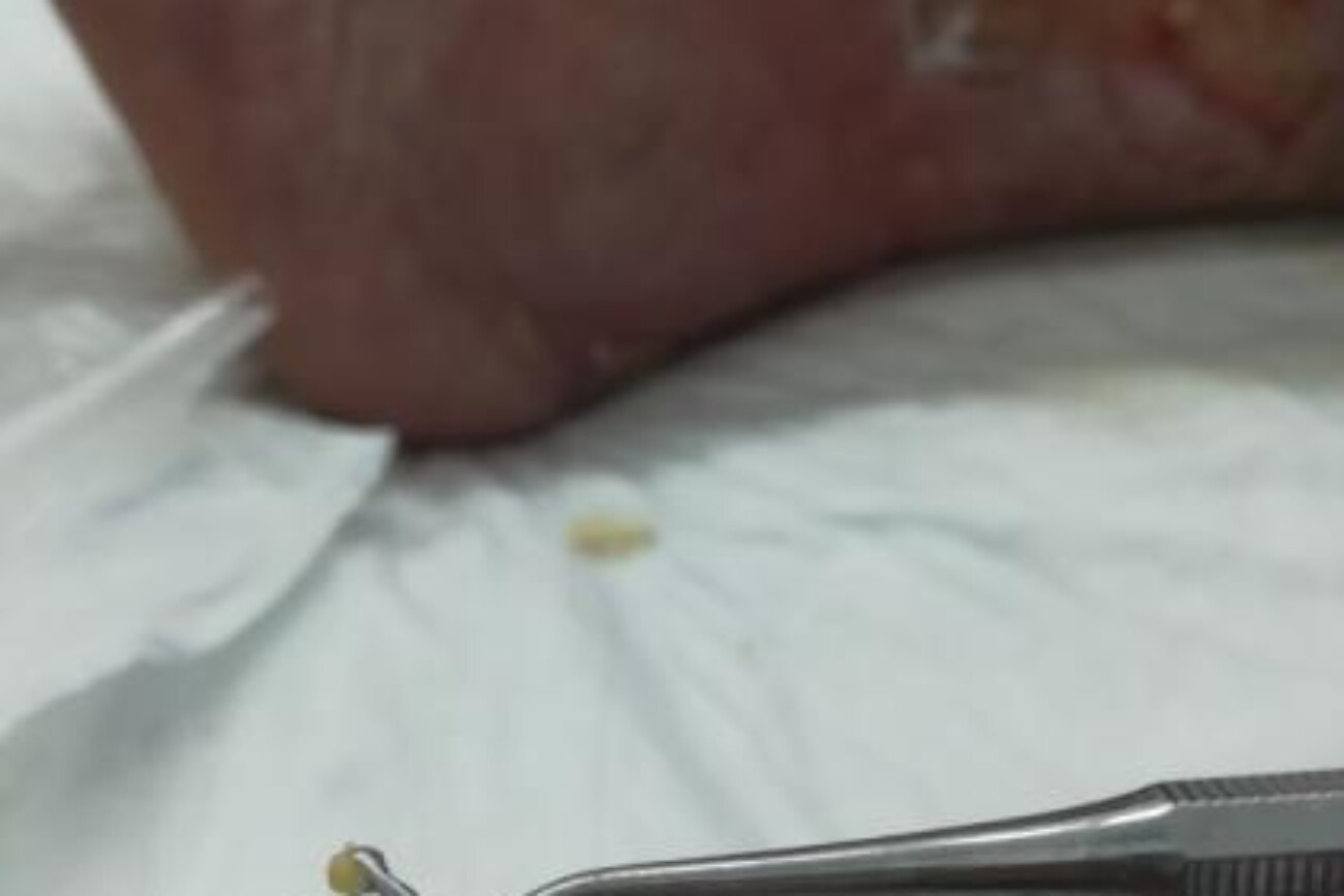 Depósitos de calcio