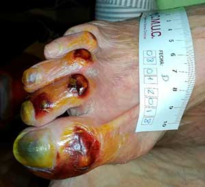 Úlceras isquémicas