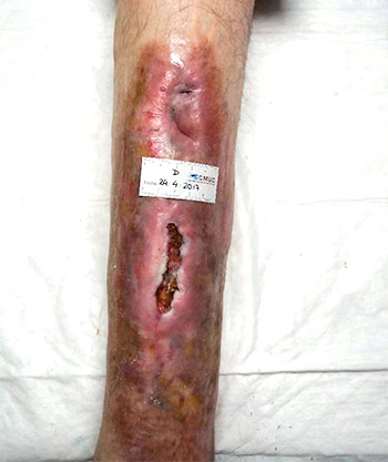 Ilustración 1. Hueso expuesto con osteomielitis, en paciente con úlcera vascular.