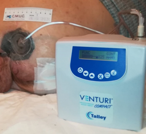 TPN: 300 ml. Exudado moderado