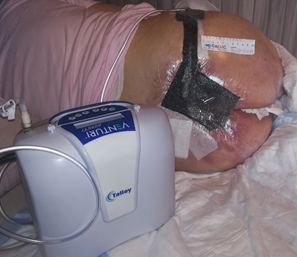 TPN: 1200 ml. Exudado abundante