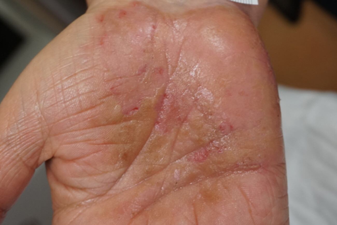 mano después de usar EPIs