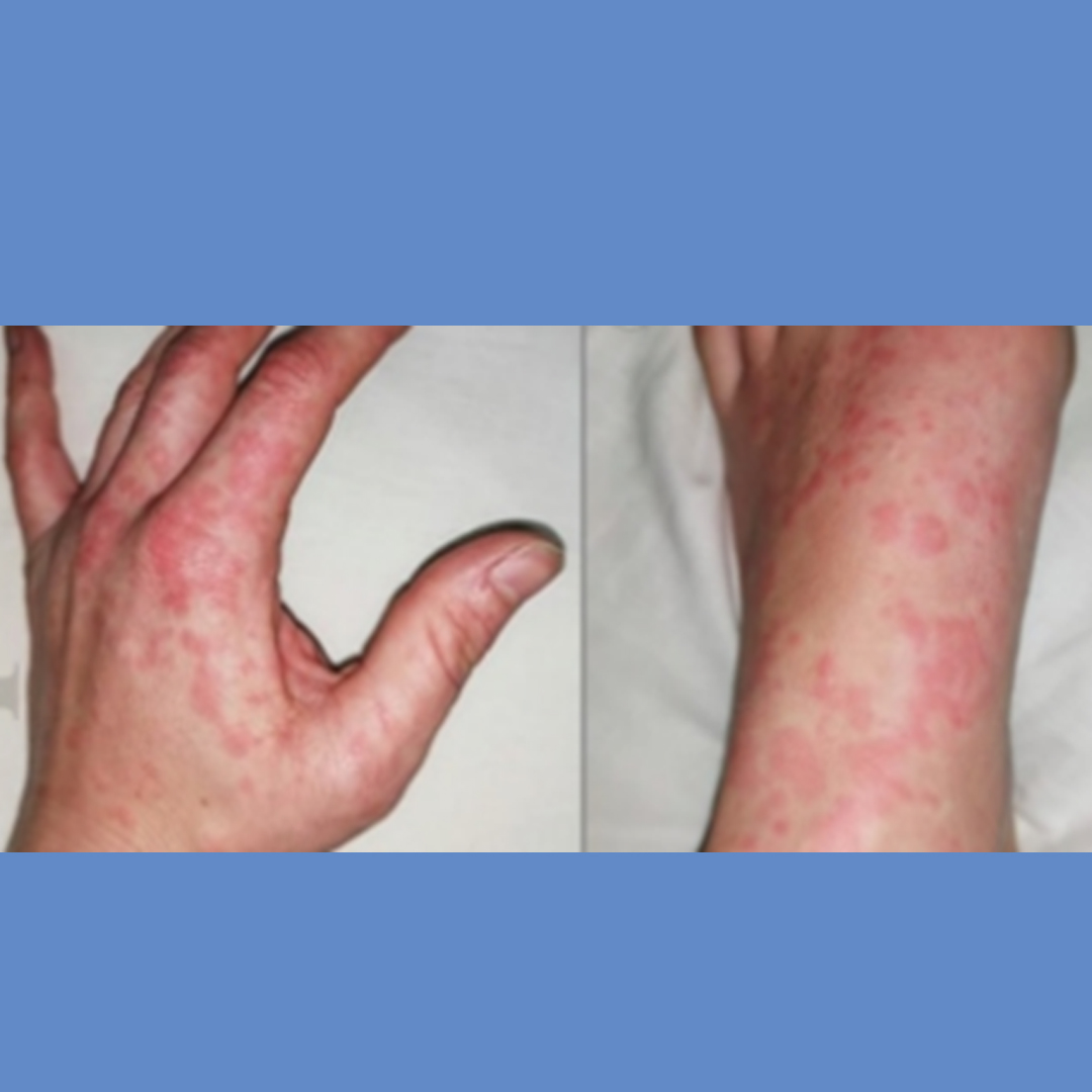 Urticaria 02