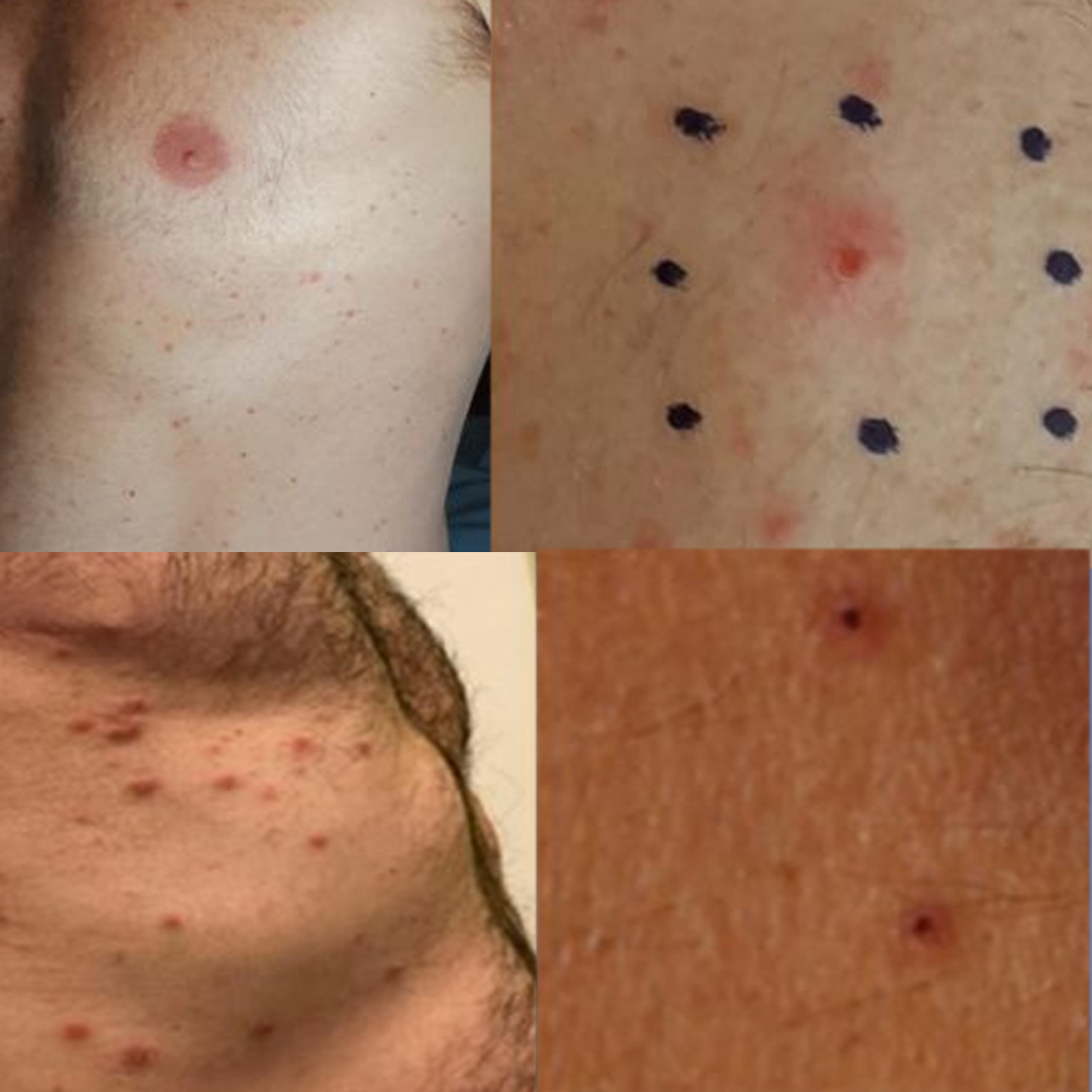 lesiones vesiculares