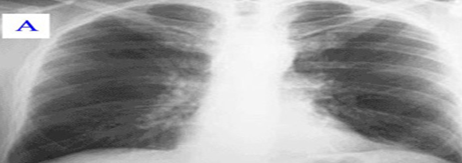 pulmones sanos vistos con TC