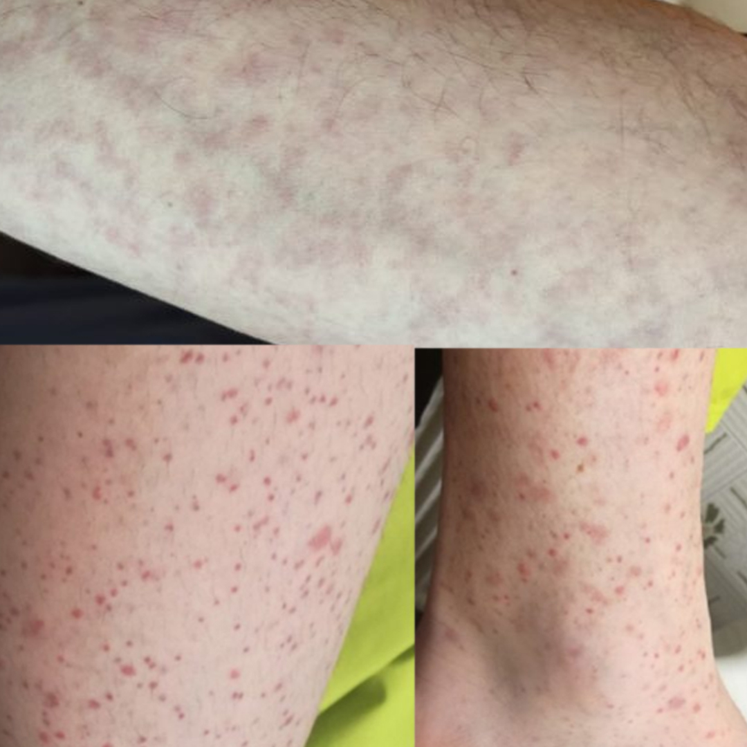 rash máculo-papular