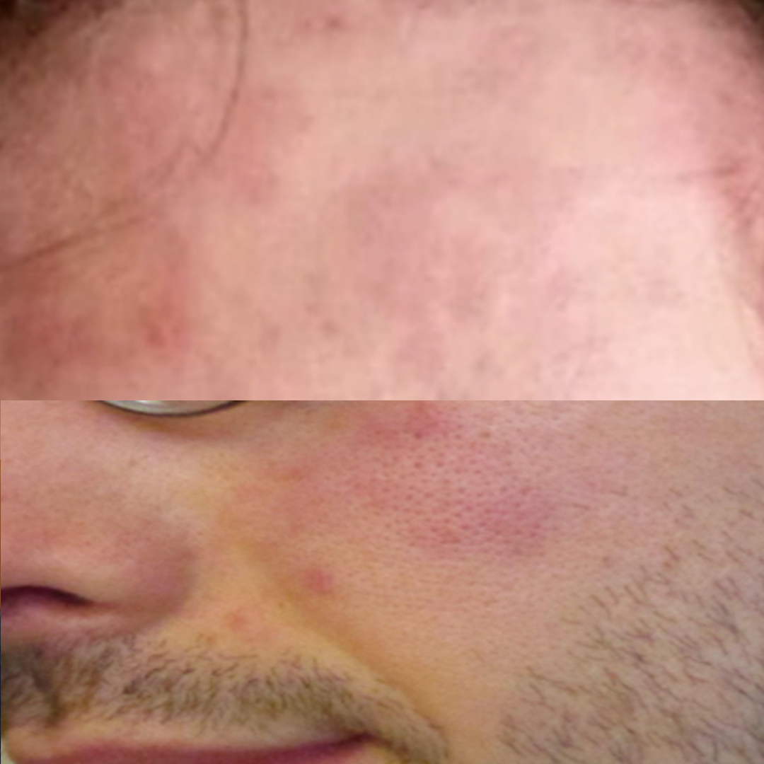 urticaria