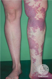 Malformaciones capilares