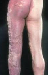 Malformaciones venosas