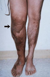 grupo b crecimiento anormal