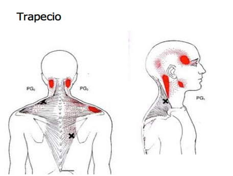 Zona de irradiación del músculo trapecio