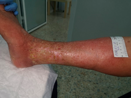 celulitis infecciosa signos